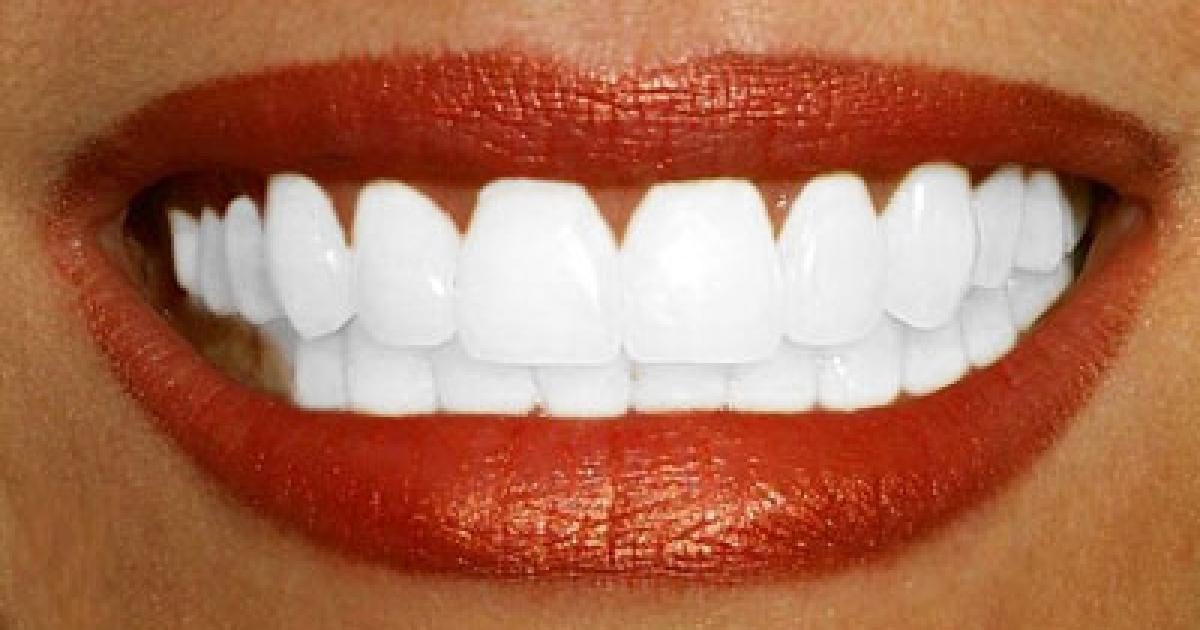 dents-blanches-astuces-blanchiment-bars-a